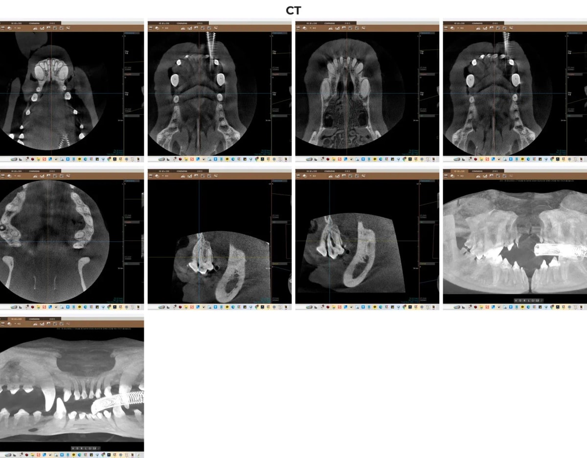치과 전용 CT를 통한 비전이의 치조골 및 치아 뿌리 정밀 진단 영상