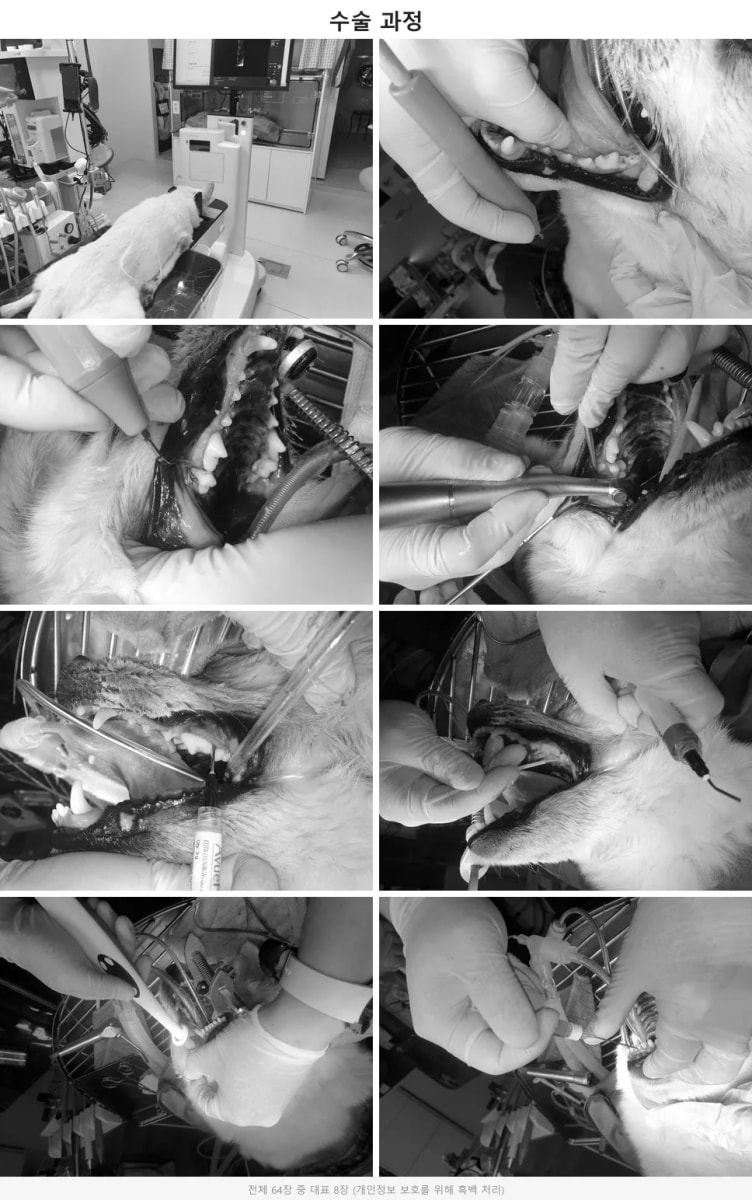 에칭&본딩 및 엠도게인 치주 재생 치료 수술 과정