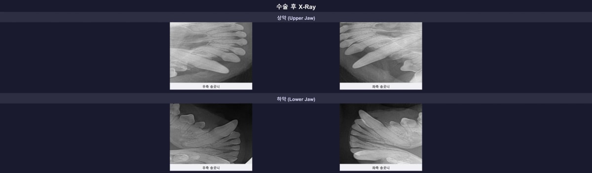 발치 및 보존 치료 후 엑스레이 검사 결과