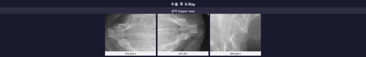잔존 치근 없이 깔끔하게 완료된 수술 후 엑스레이