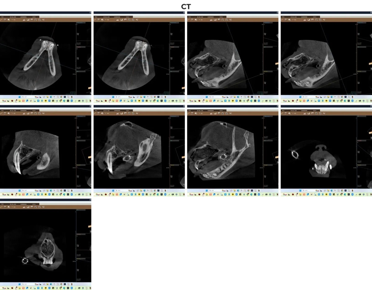 겨울이의 치과 전용 CT 촬영 영상
