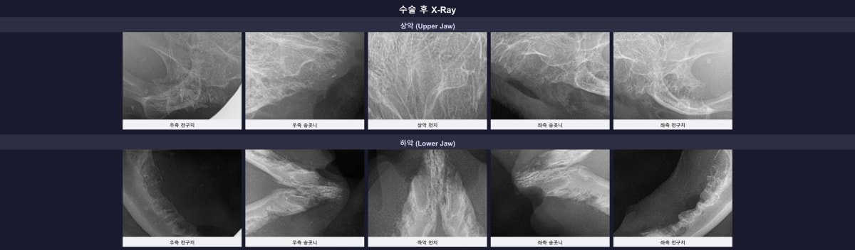 수술 후 잔존 치근 없이 깨끗하게 비워진 동글이의 치과 엑스레이