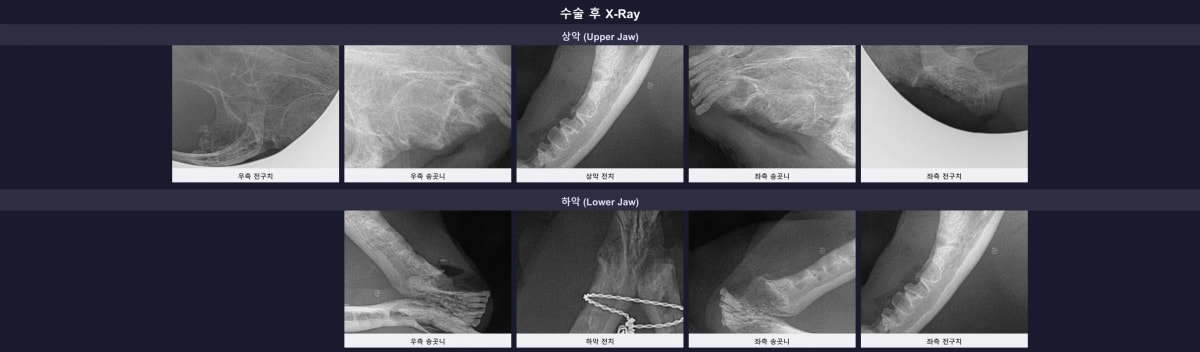 수술 후 와이어링 보강 상태와 깨끗하게 제거된 잔존 치근을 확인하는 엑스레이