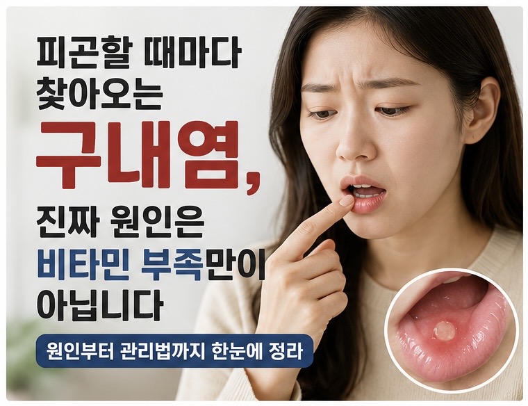구내염