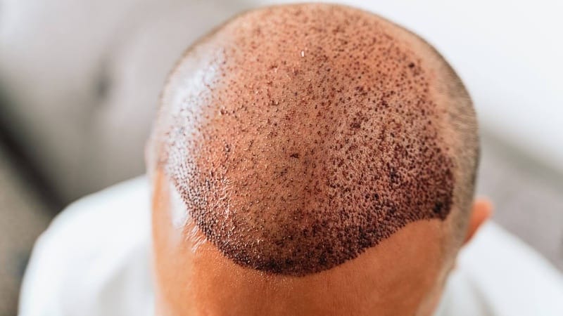Hair Transplant: A Permanent Solution for Hair Loss