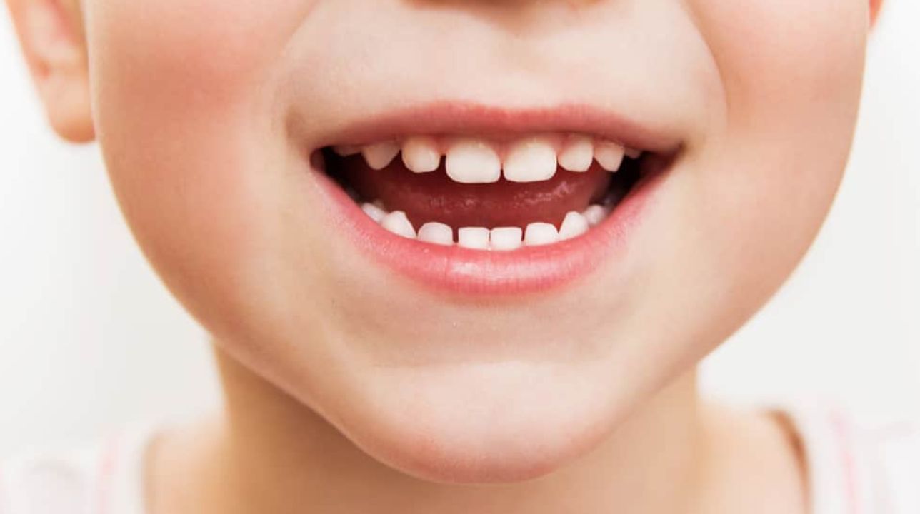 Kesihatan Gigi Susu Anak Sebelum Jenis Kekal Tumbuh Penting- DoctorOnCall