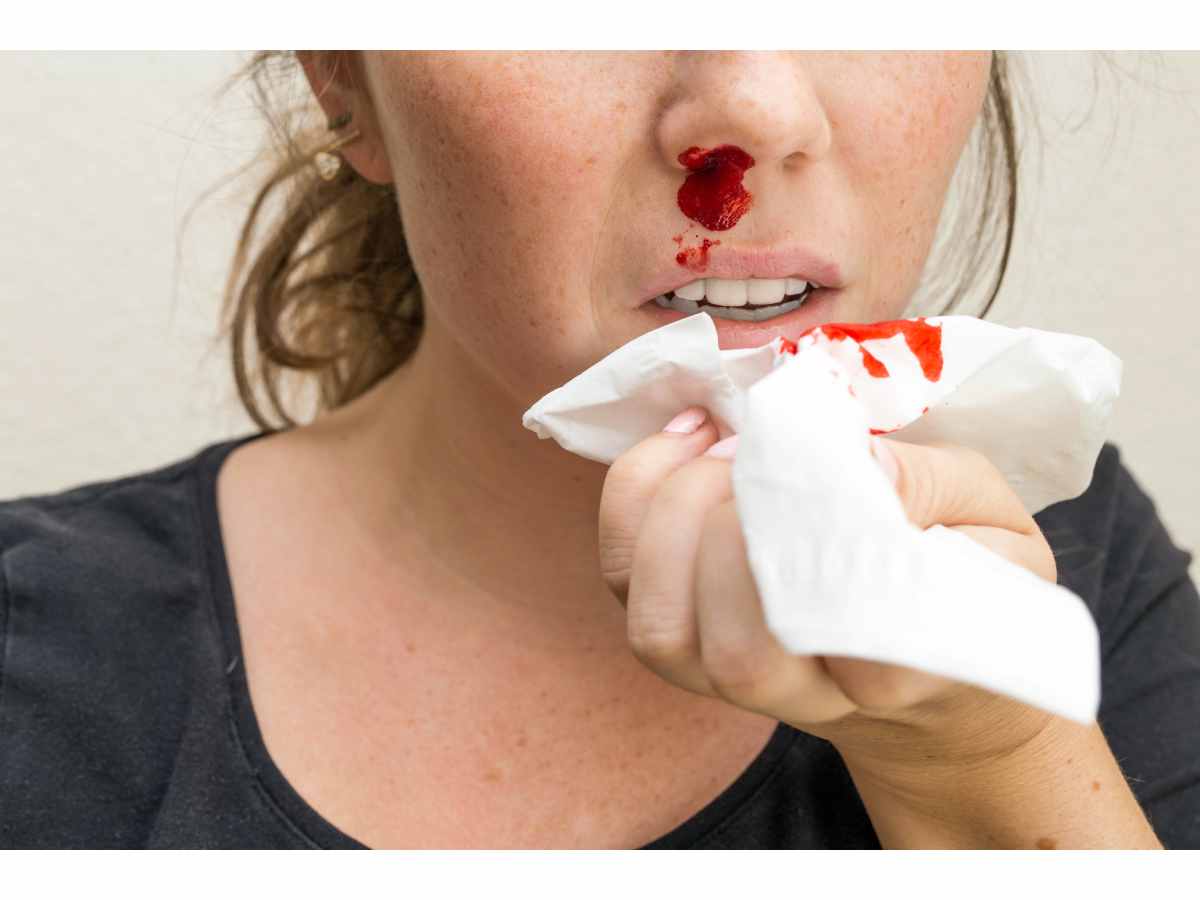 Hidung Berdarah Secara Tiba-Tiba, Cara Merawat Pendarahan - DoctorOnCall