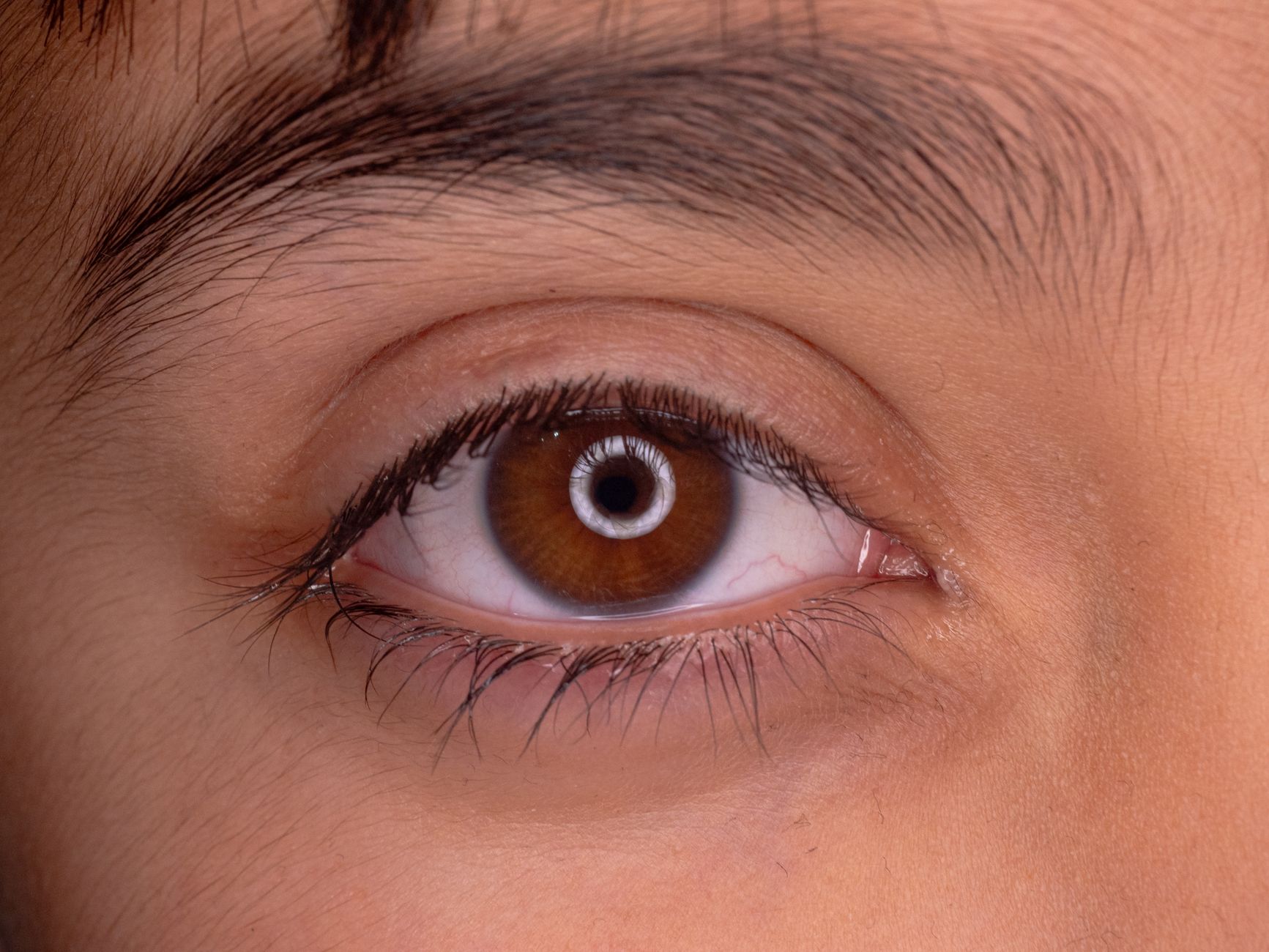 Newborn with swollen eye and discharge