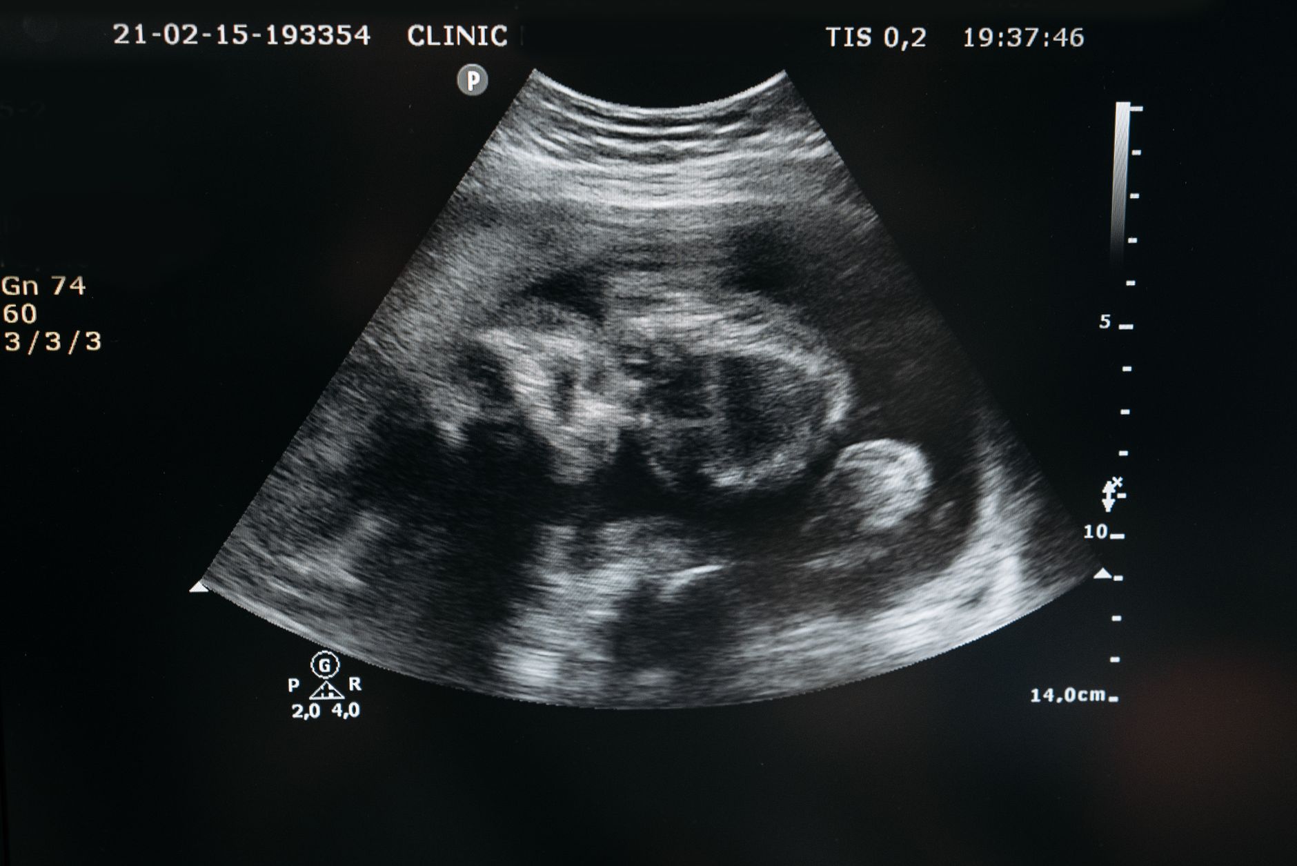 Transvaginal ultrasound image showing an empty uterine cavity with a gestational sac located in the interstitial (cornual) region of the fallopian tube
