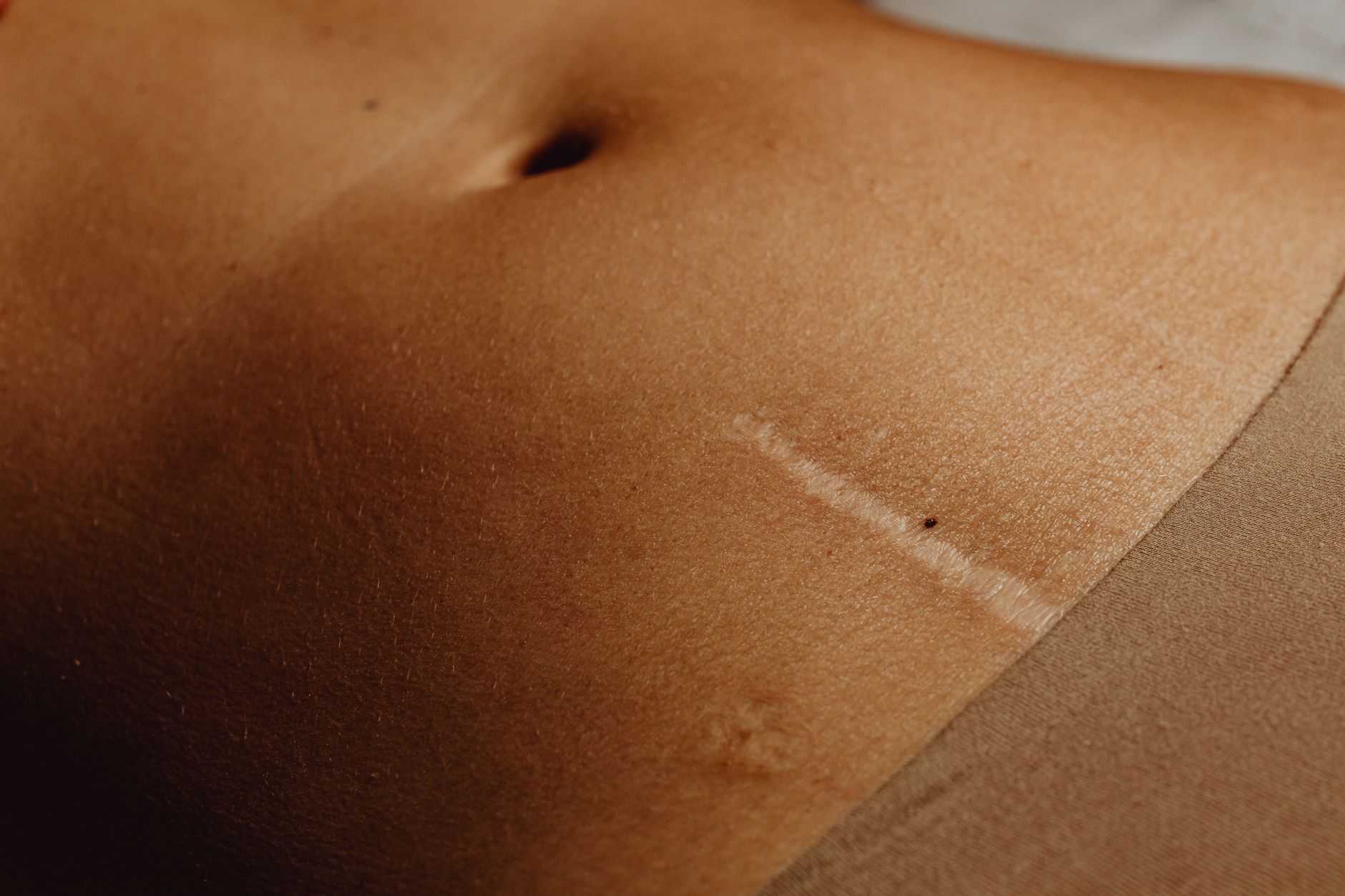 Hernia and Pregnant: Types, Symptoms, and Safe Treatment Options