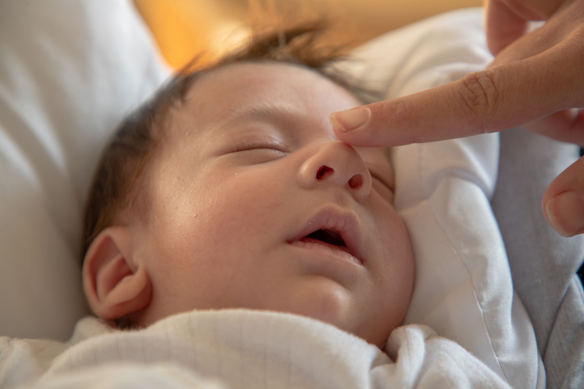 Jaundice in Newborns: When Phototherapy Is Needed? Use Our Calculator