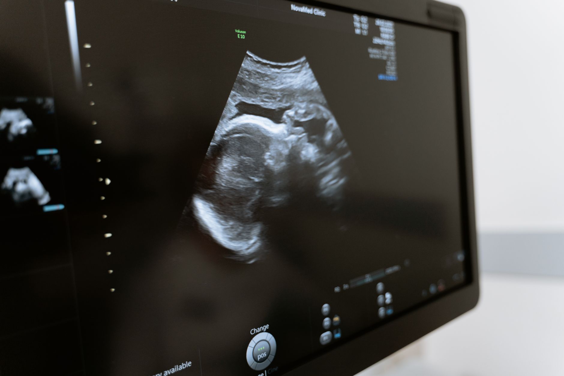 Close‑up of a prenatal ultrasound screen showing a fetus with a large fluid pocket, with a clinician pointing at the measurement, soft lighting in a clinic room