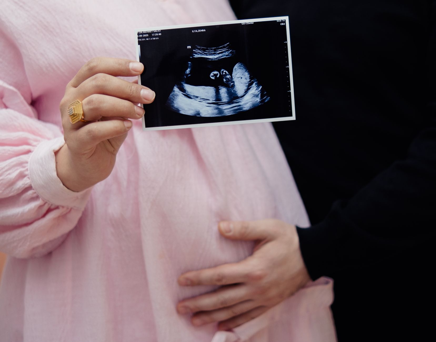 Preterm labor: Betamethasone vs dexamethasone