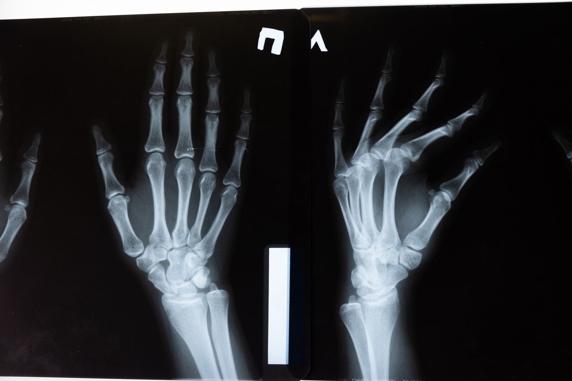 Radiograph of a child's left hand showing bone age, soft lighting in a radiology suite, clear image of growth plates