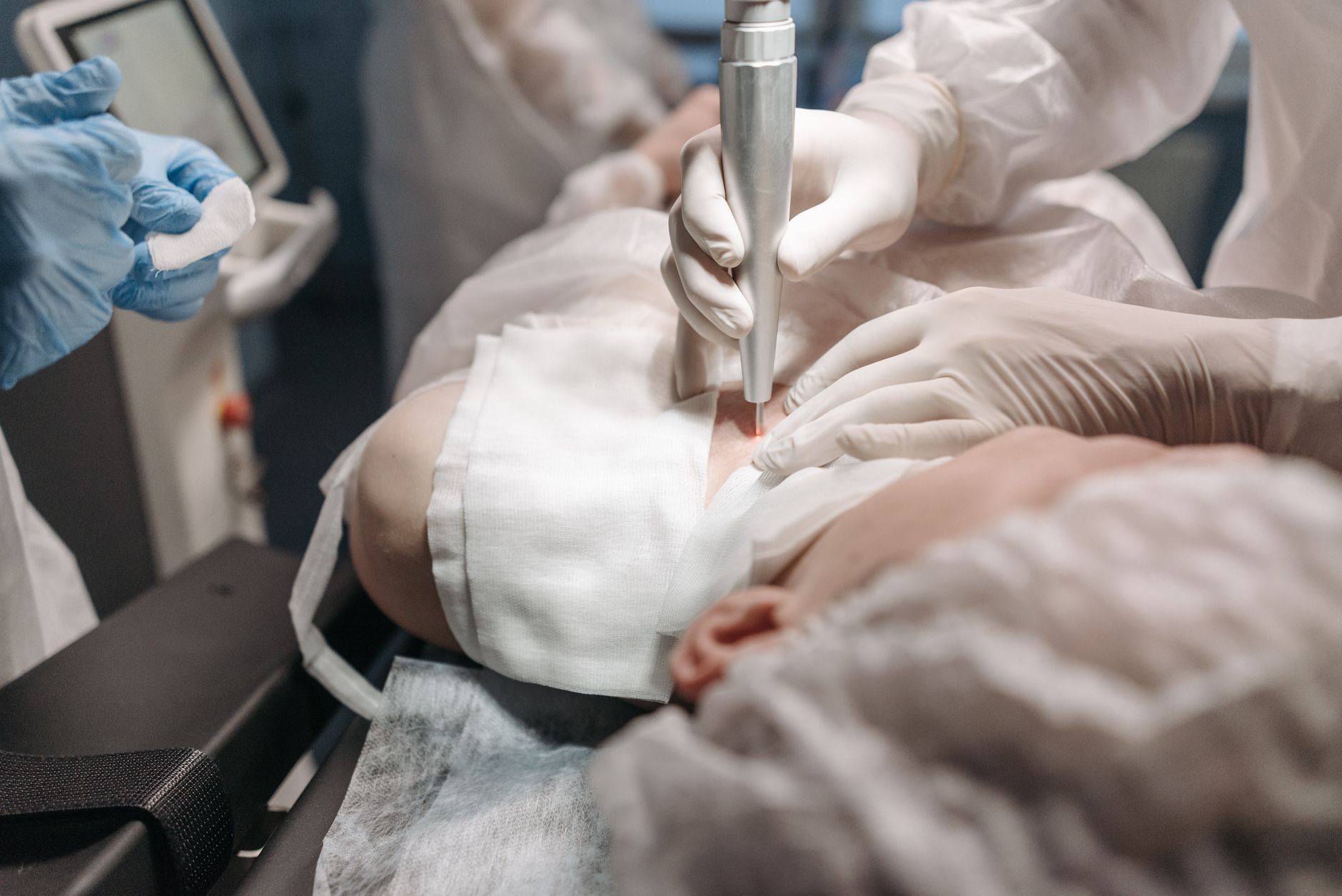 Dermatology laser treatment for stretch marks