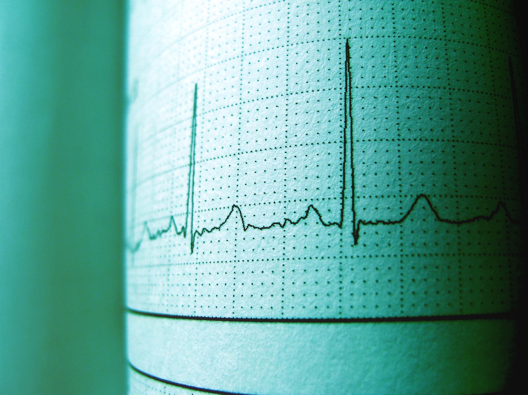 Illustration of Sarnat stage III neonate with severe hypotonia, flat EEG trace on monitor, and supportive neonatal equipment