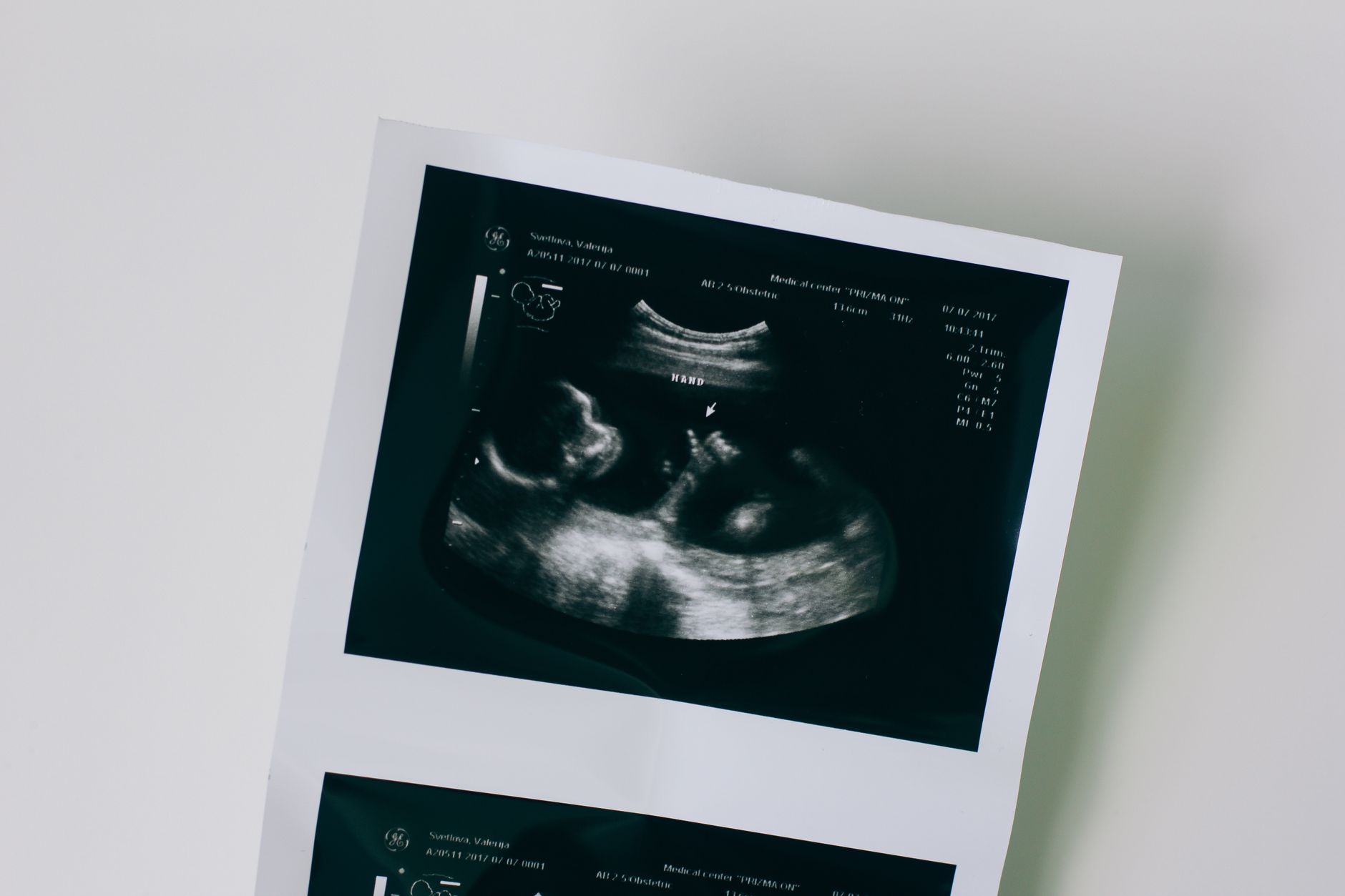 Ultrasound of baby engagement