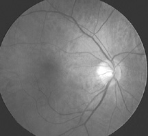 A typical ophthalmoscopic photograph showing the characteristic pattern of blood vessels diverging from the optic cup. A typical ophthalmoscopic photograph showing the characteristic pattern of blood vessels diverging from the optic cup.