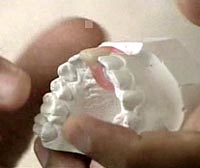 Small ultrasound device for stimulating teeth healing and dental tissue formation