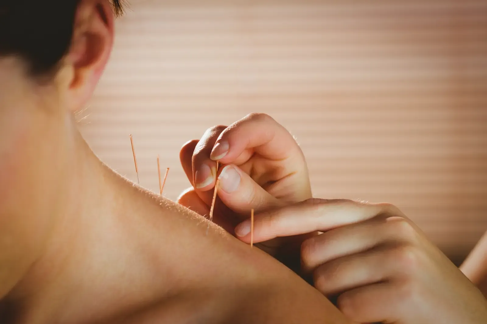 Acupuncture needles being placed at the shoulder and upper back