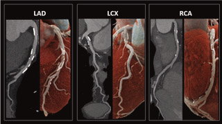 Coronary CT: the precision 'radar' for your heart – evidence, risks andpPrecautions