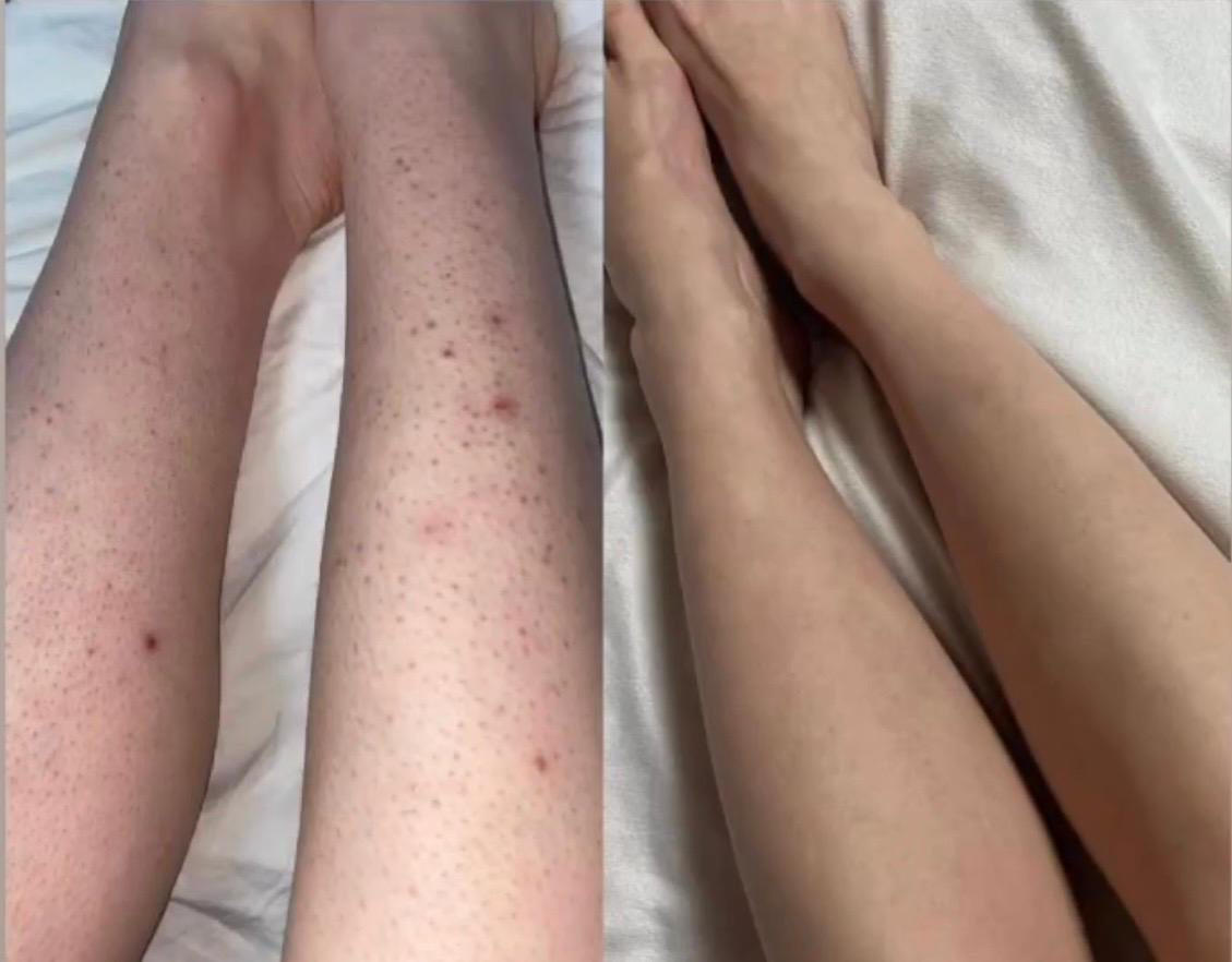 Epilarea Definitivă: Mituri și Adevăruri – Tot ce Trebuie să Știi despre Laserul Diodă