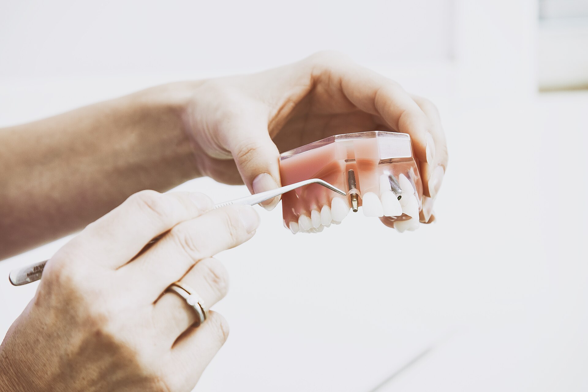 Dentist explaining treatment on an implant model