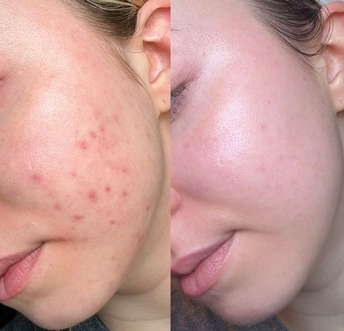 Acne and breakouts