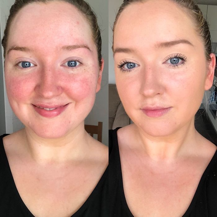 Redness and irritation