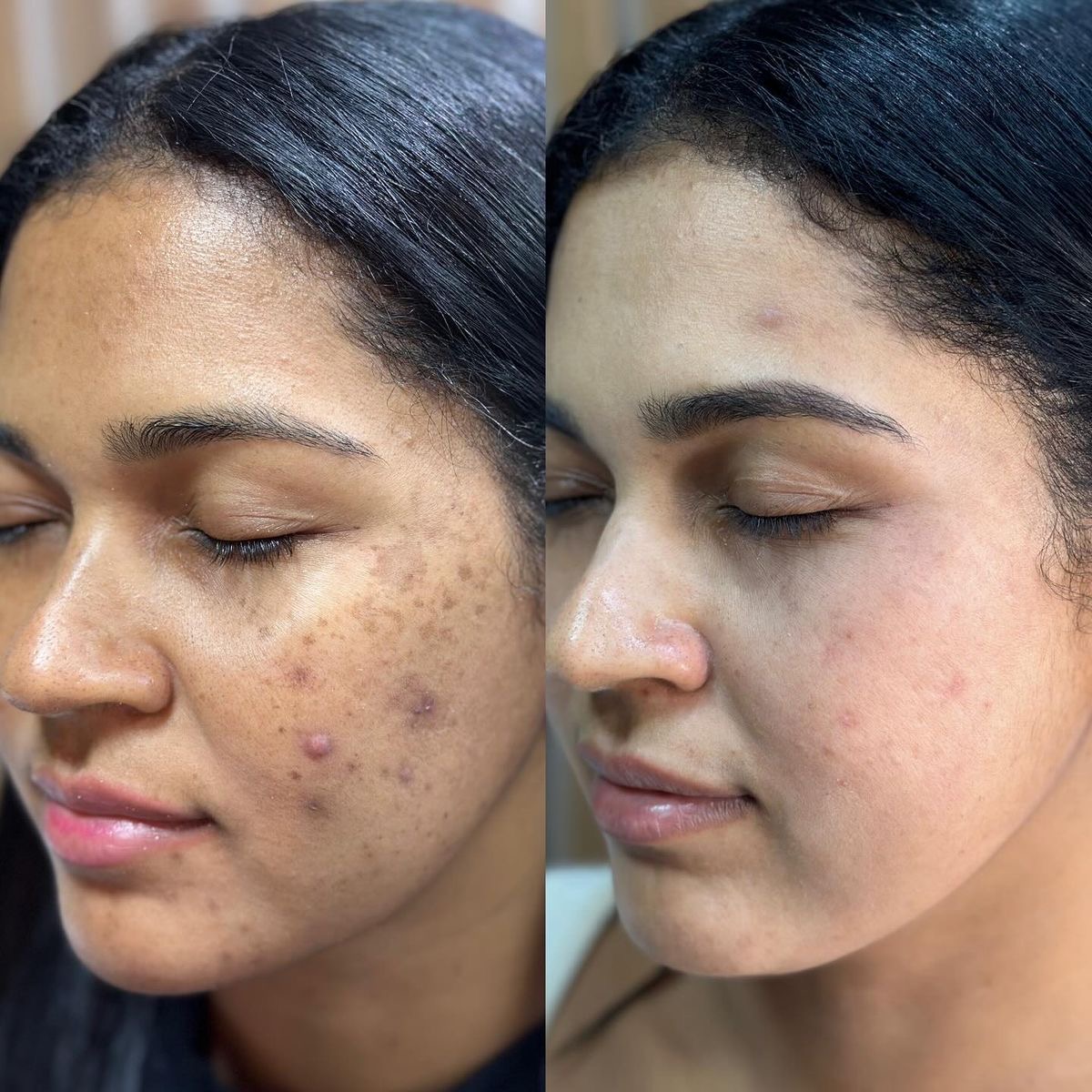 Dark spots and pigmentation