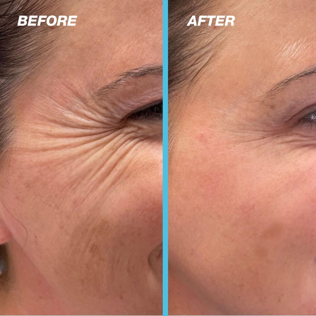 Anti-aging and wrinkles