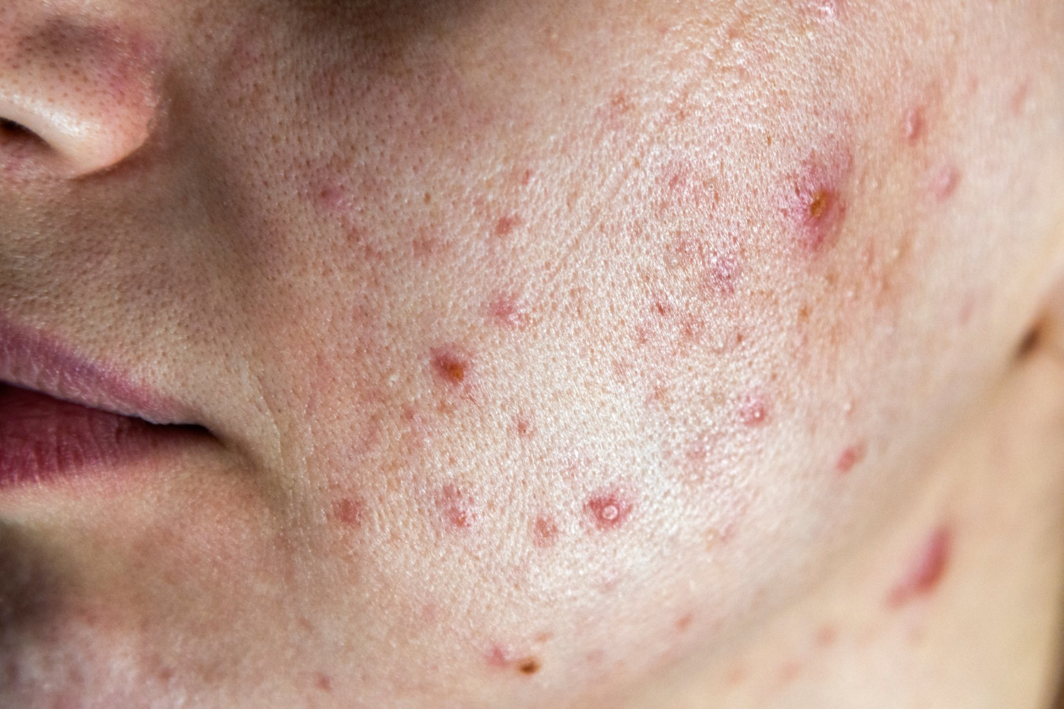 Close-up of clogged pores and acne formation on the skin.