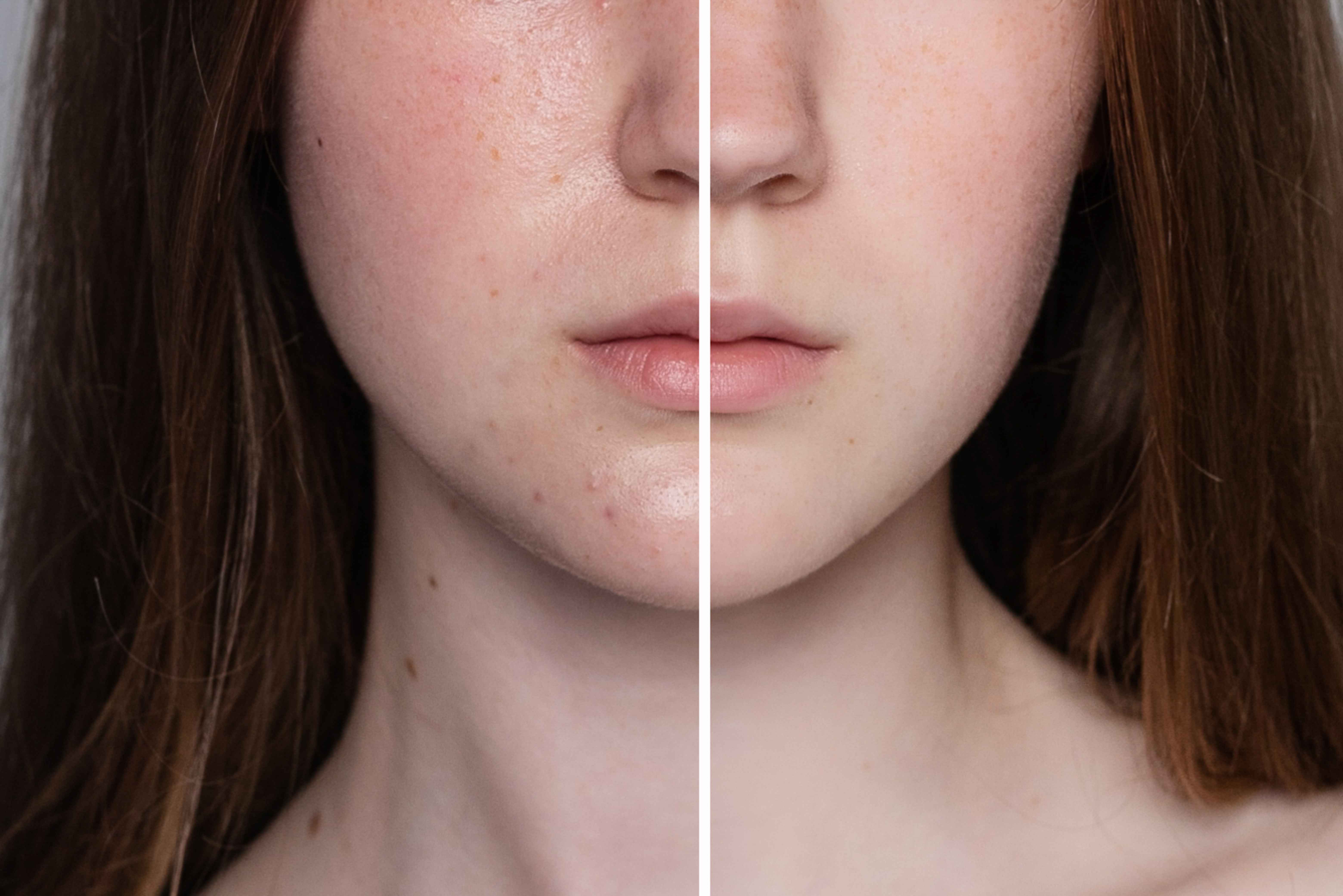 A side-by-side comparison of normal and enlarged pores on facial skin.