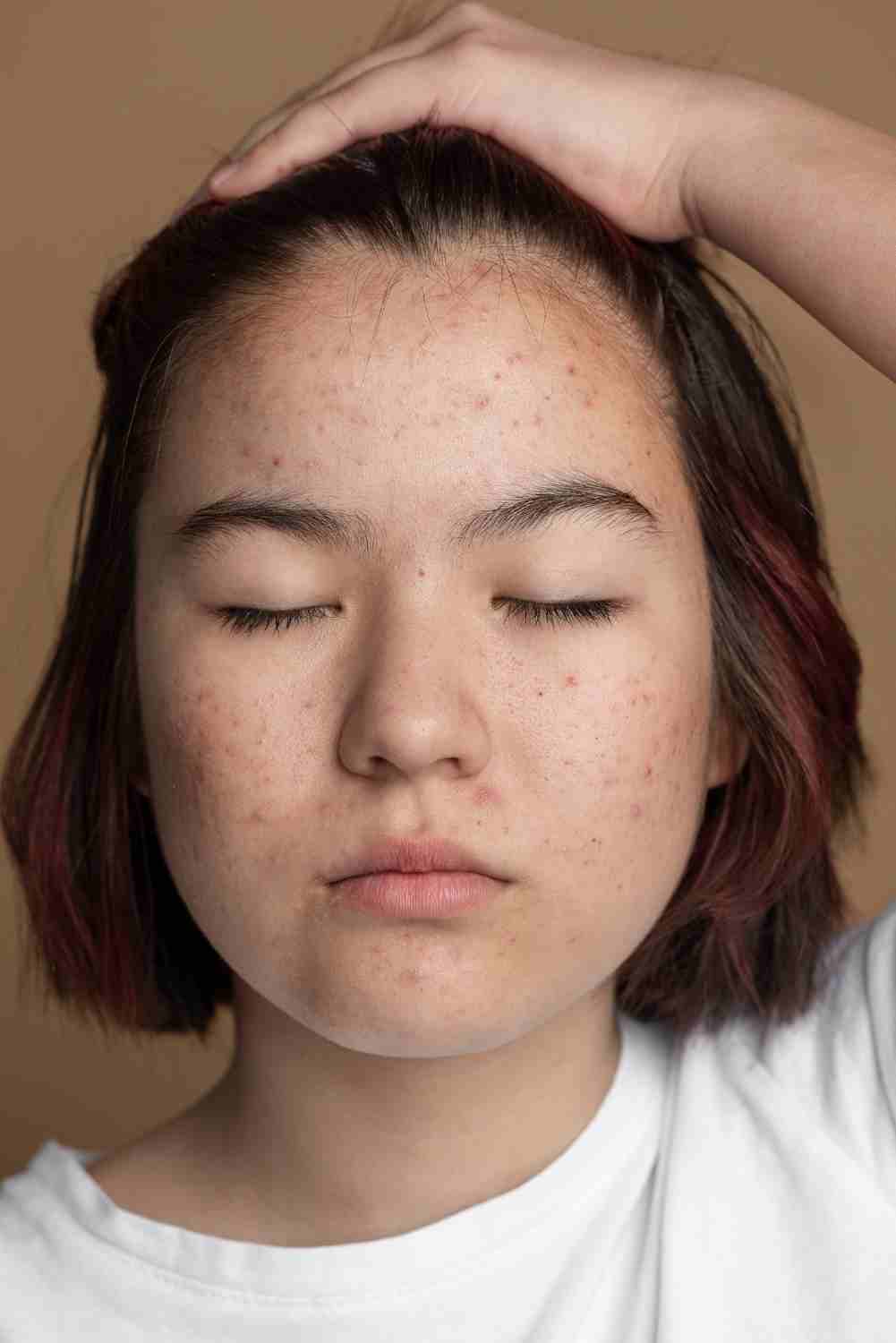 A close-up of flushed cheeks with small red bumps on fair skin.