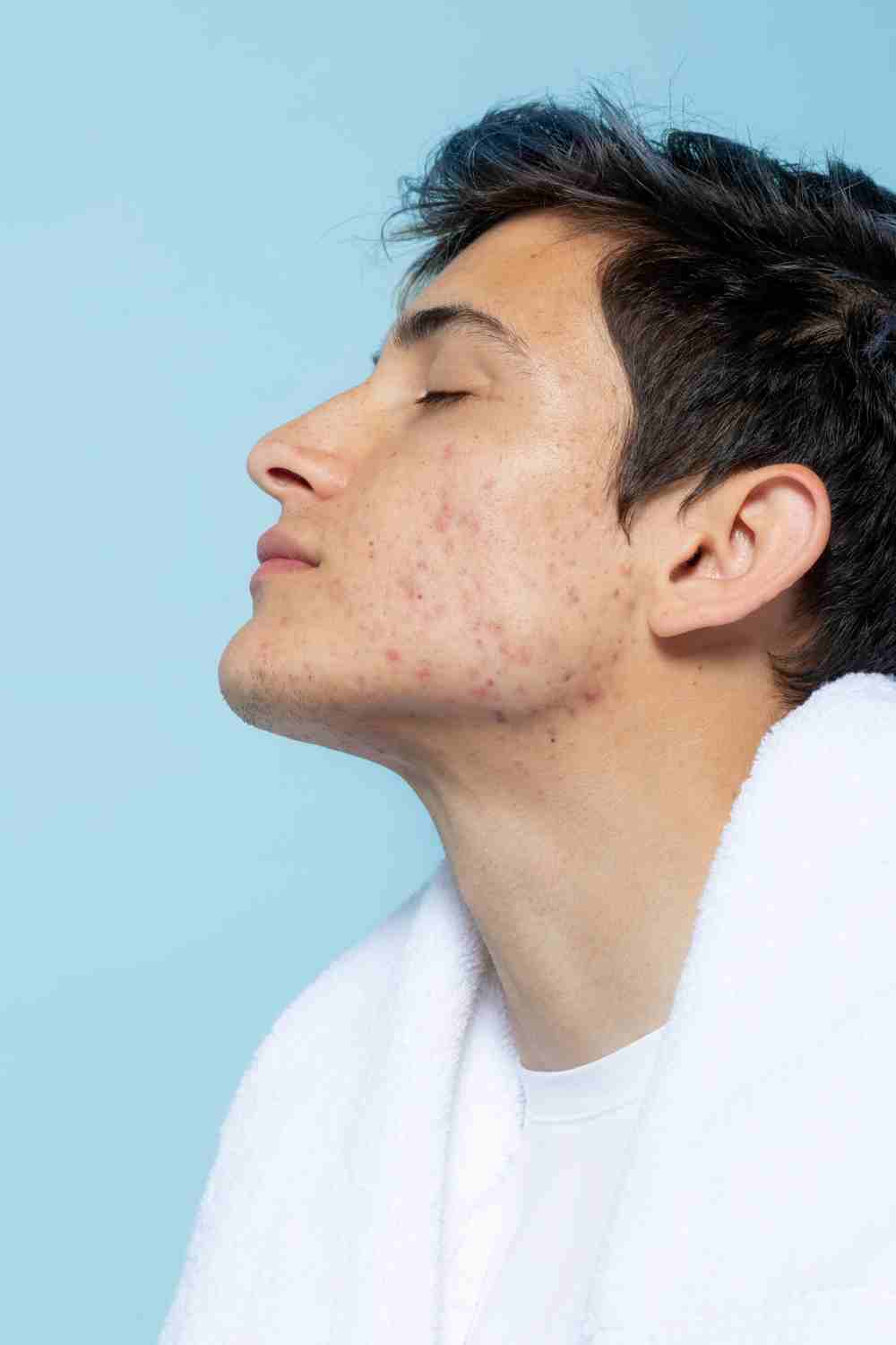 A person with faint red spots on the cheeks after acne flare-ups.