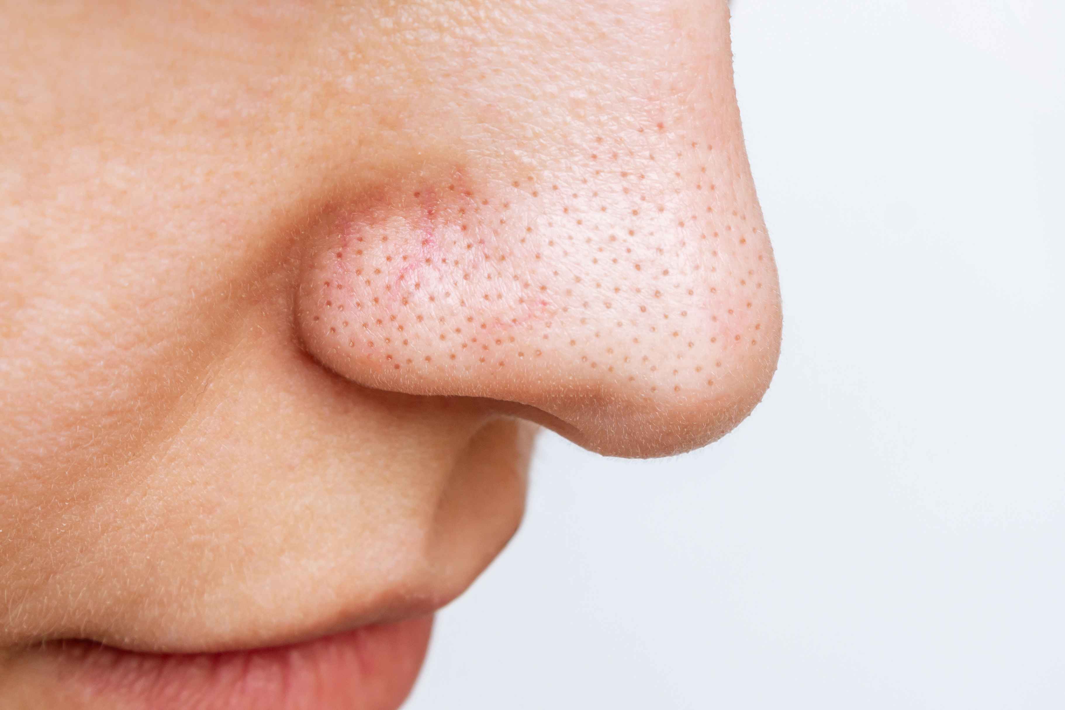 How to Get Rid of Large Pores and Minimize Their Appearance