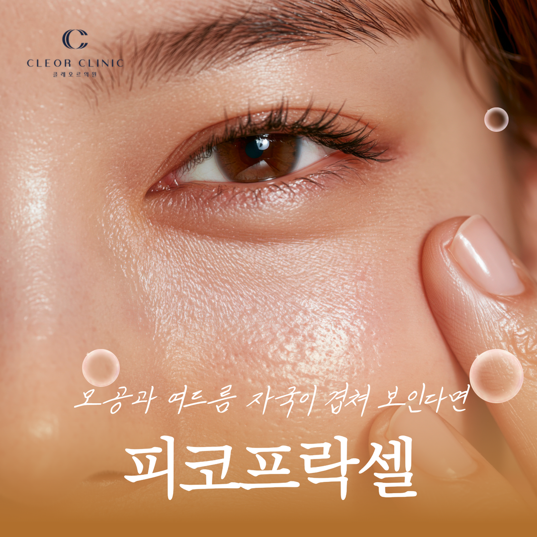 Gangnam Pico Fraxel for overlapping pores and acne scars