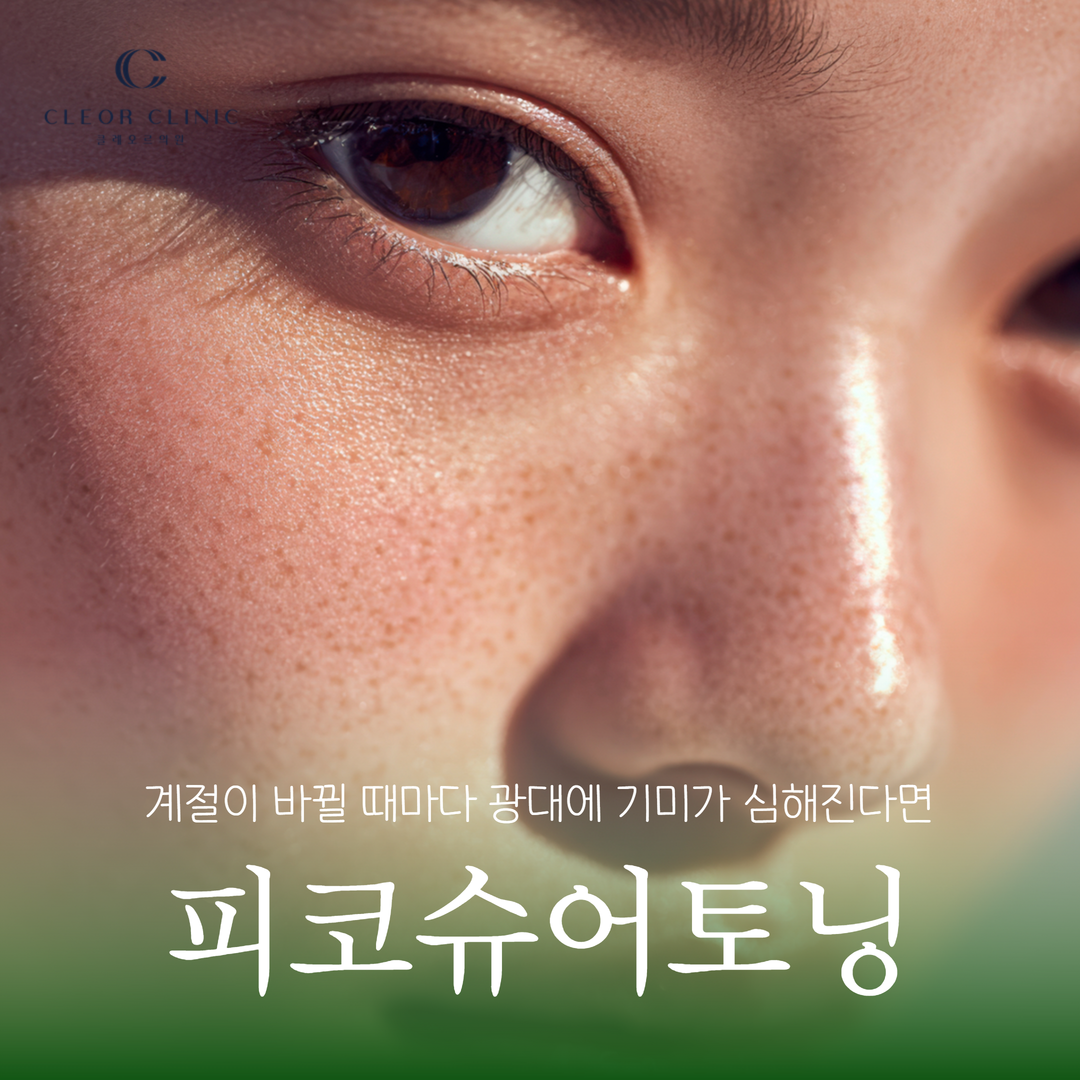 Gangnam melasma laser: If your melasma on your cheekbones worsens every time the season changes