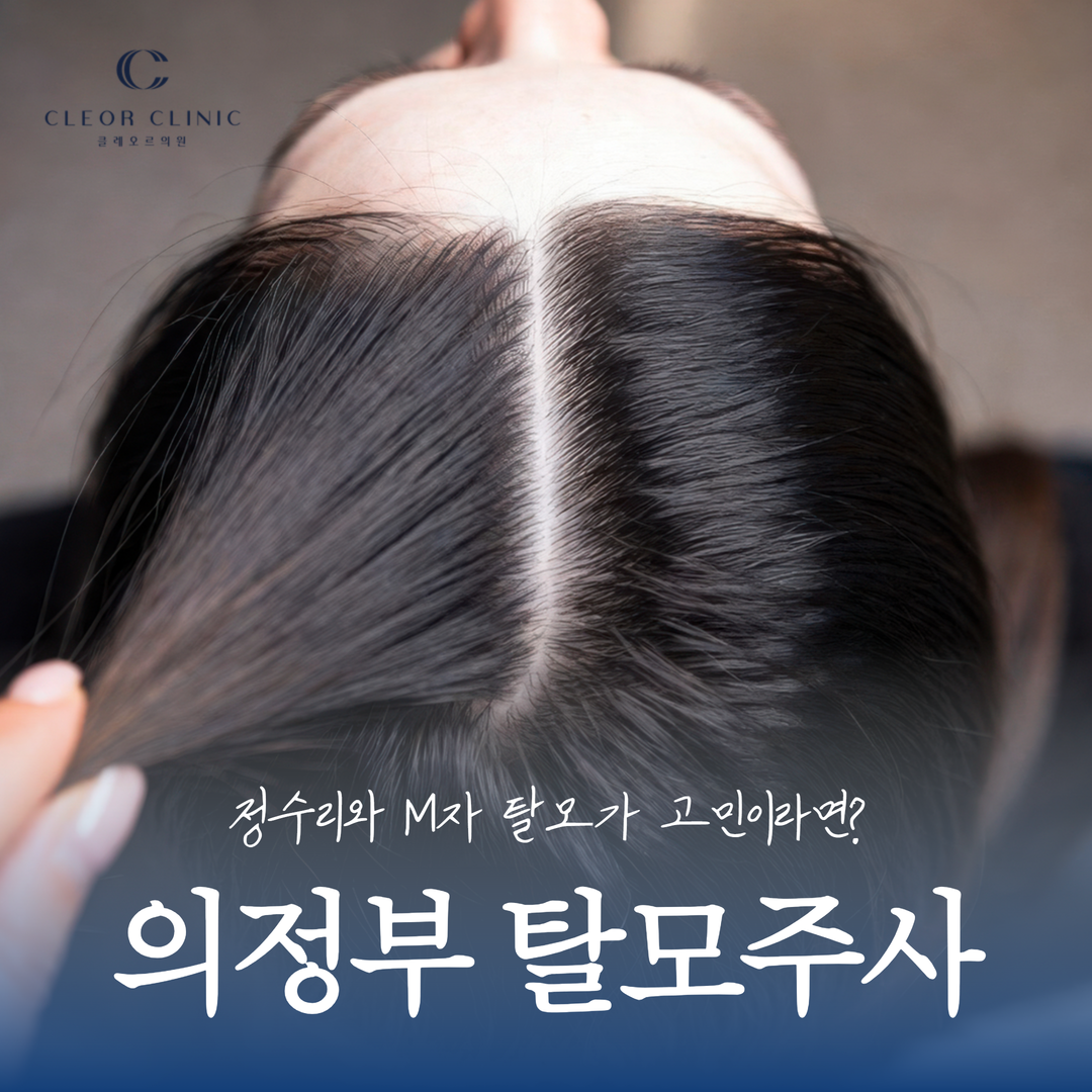 议政府脱发针 Hair Blooming，当您在意头顶和M型脱发时