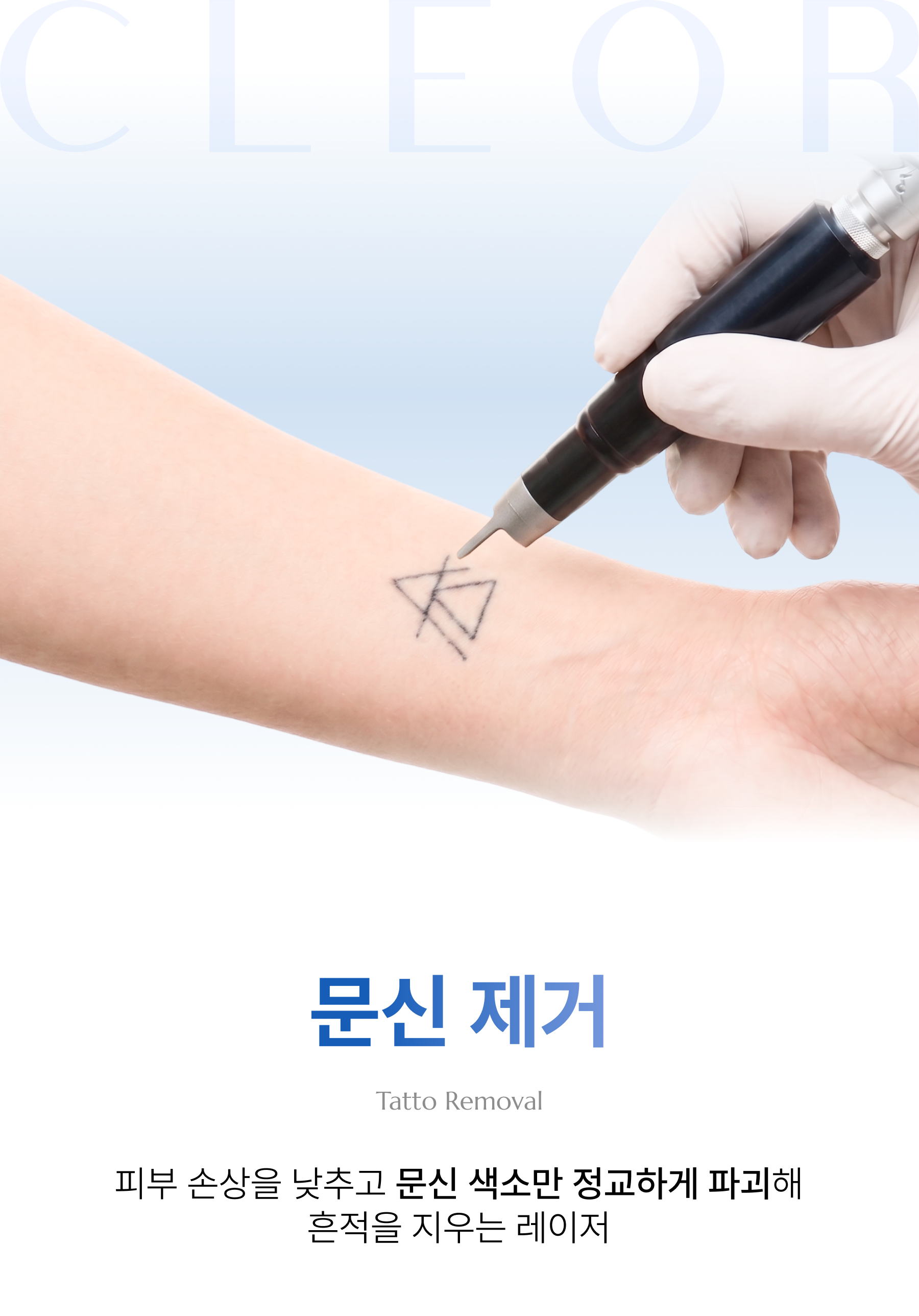 문신 제거