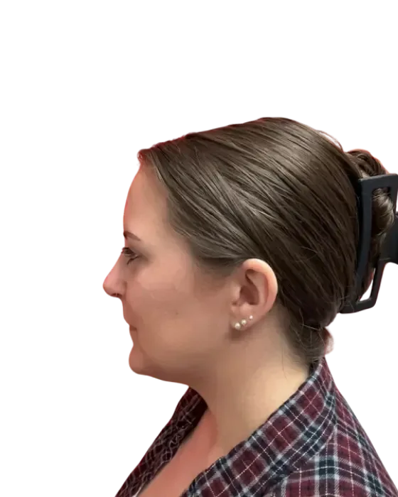 Rhinoplasty Before & After after image