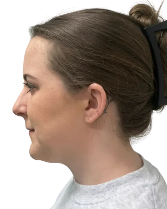 Rhinoplasty Before & After before image