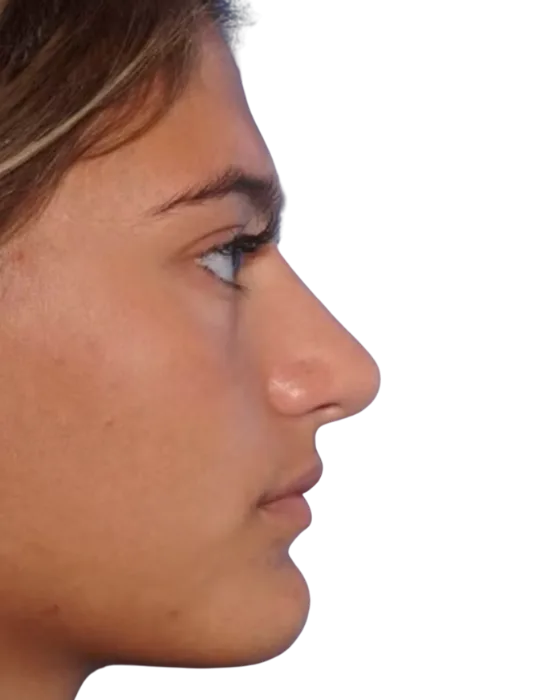 Rhinoplasty Before & After after image