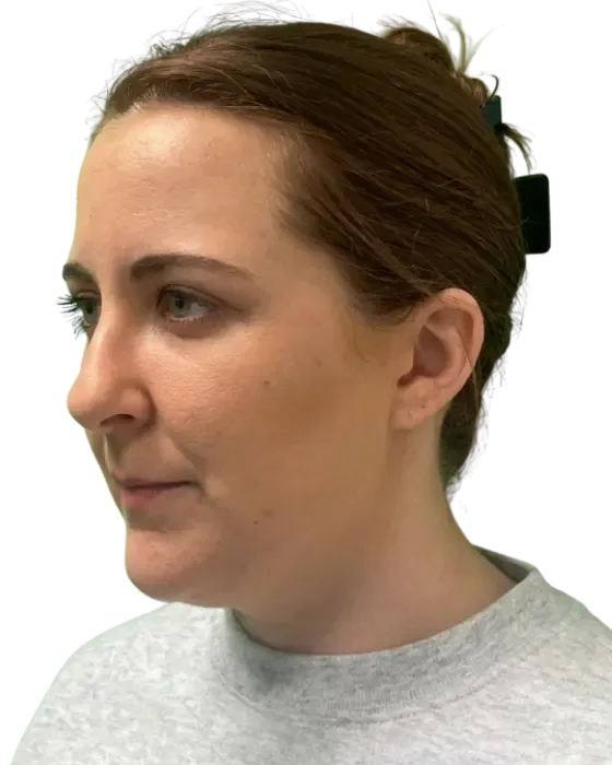 Rhinoplasty Before & After before image