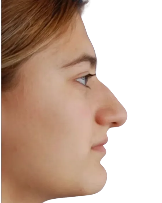 Rhinoplasty Before & After before image