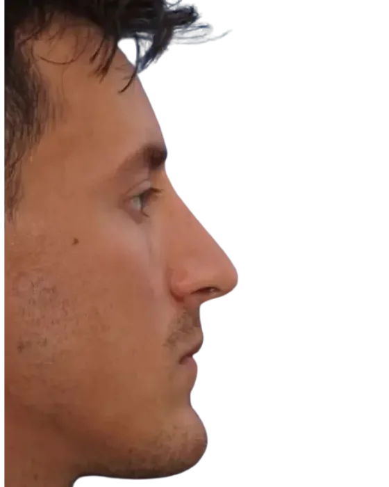 Rhinoplasty Before & After after image