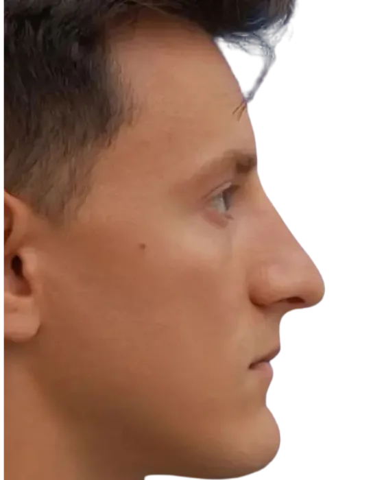 Rhinoplasty Before & After before image