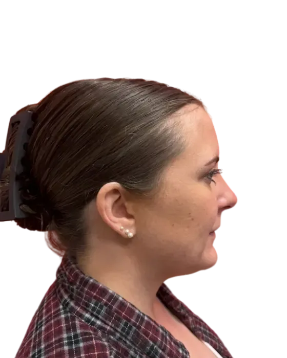 Rhinoplasty Before & After after image