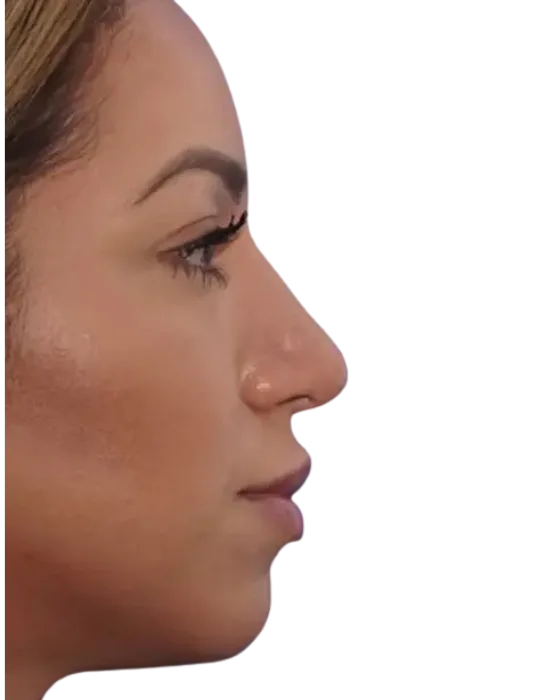 Rhinoplasty Before & After after image