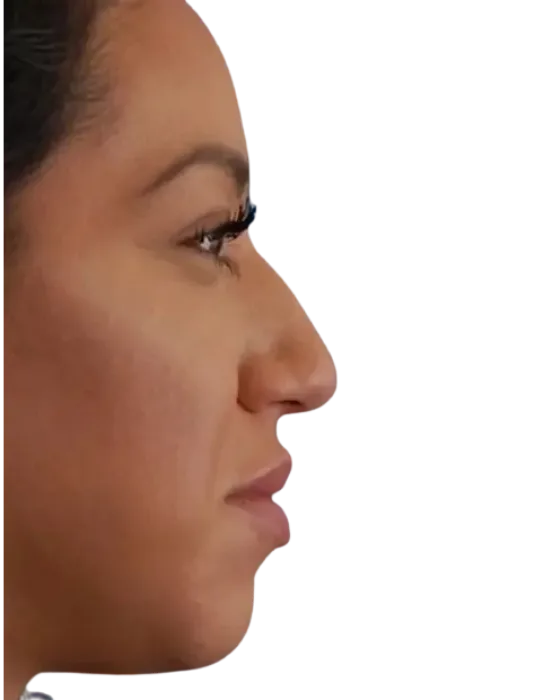 Rhinoplasty Before & After before image